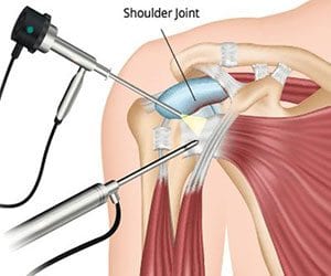 artroza ramena- ramena bol u zglobovima koljena nego anesteziranje